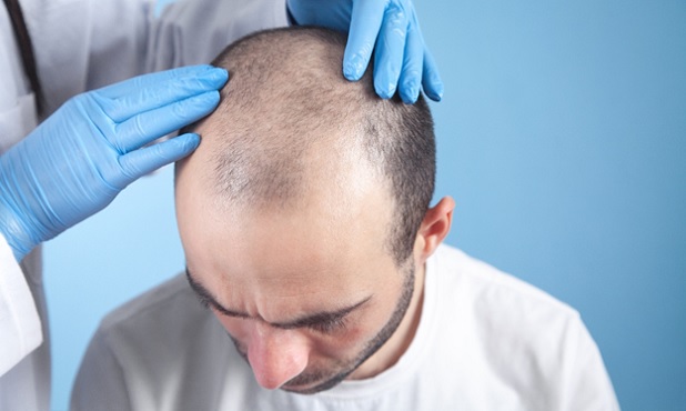 Best Hair Transplant