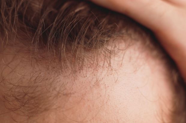 Male Pattern Baldness treatment