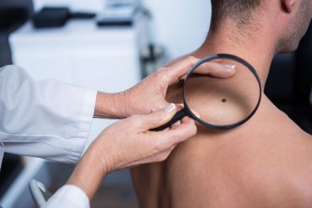 warts or mole removal treatment