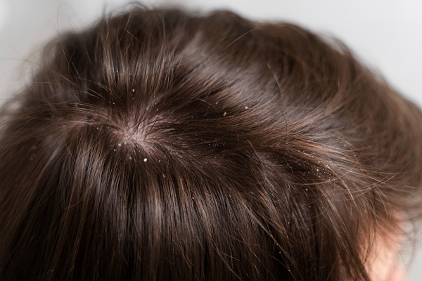 Severe Dandruff Treatment